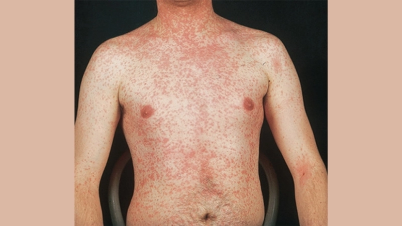 Measles (Rubeola) measles vaccine info