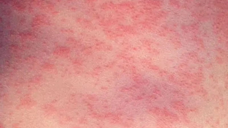Measles (Rubeola) measles treatment tips