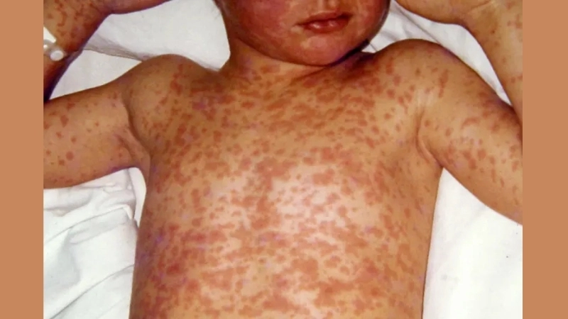 Measles (Rubeola) measles vs chickenpox
