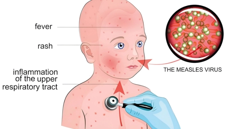 Measles (Rubeola) measles contagious period