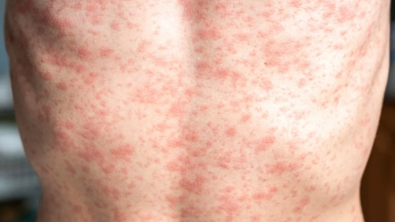 Measles (Rubeola) measles complications