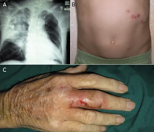 Recognizing the diverse melioidosis symptoms