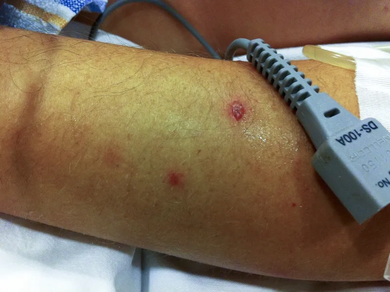 An overview of the latest melioidosis treatment