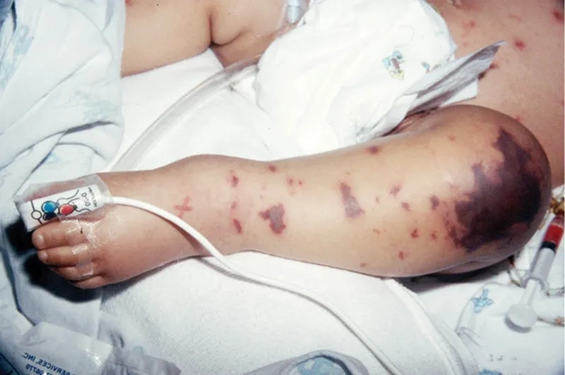 An overview of treatment for meningococcal disease