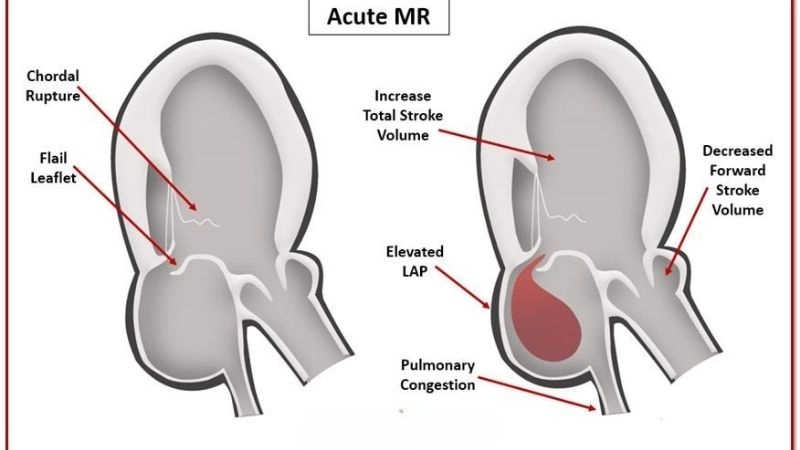 Mitral Regurgitation Symptoms include fatigue and dyspnea