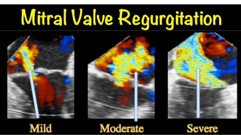 Mitral Regurgitation Treatment improves heart performance