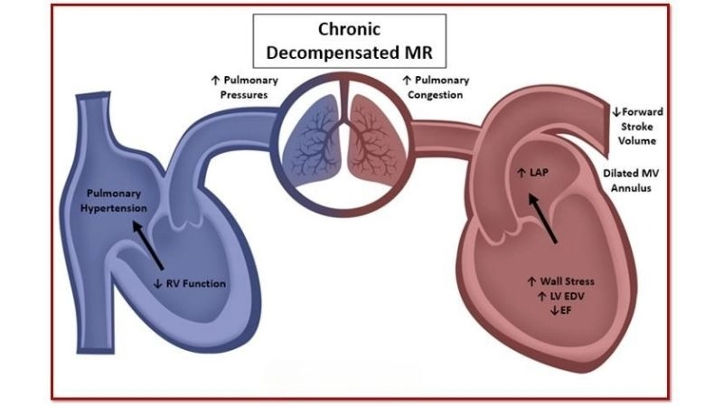 Mitral Valve Prolapse common trigger of regurgitation
