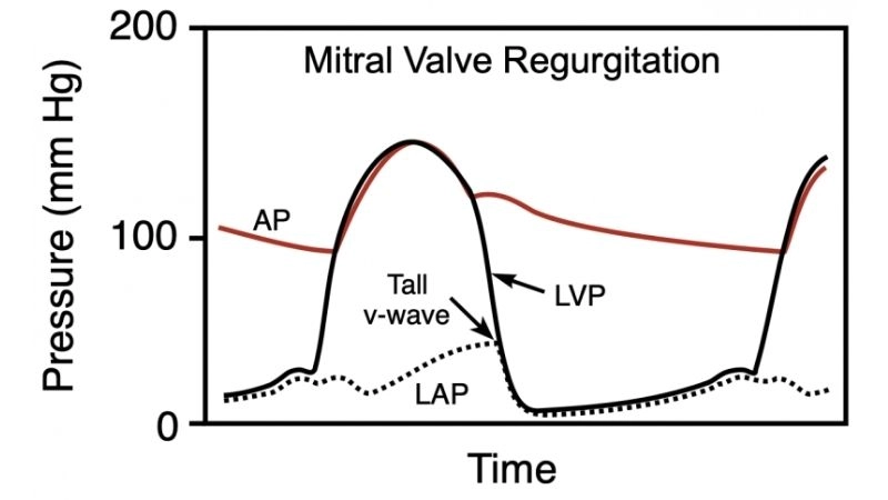 Mitral Regurgitation Surgery restores healthy blood flow