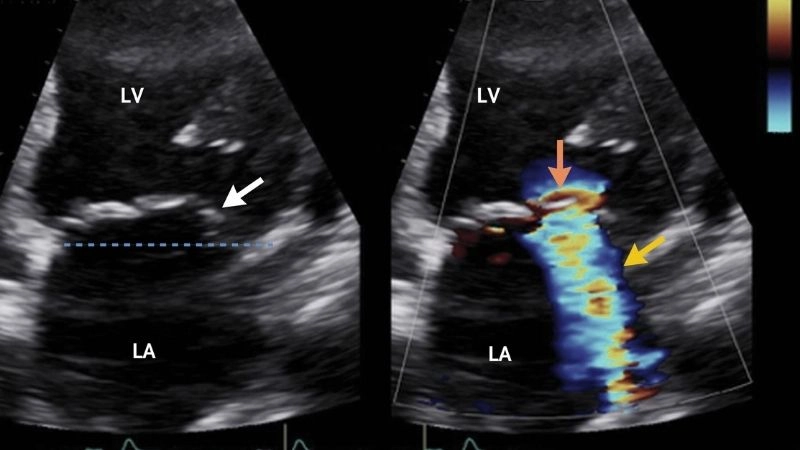 Severe Mitral Regurgitation raises risk of heart failure