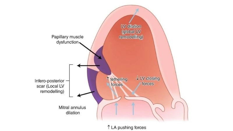 Functional Mitral Regurgitation linked with ventricular dilation
