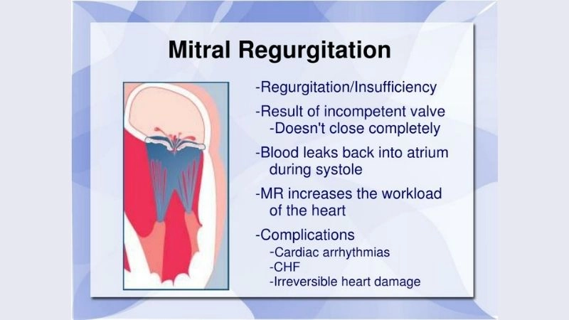 Causes Of Mitral Regurgitation include prolapse and damage