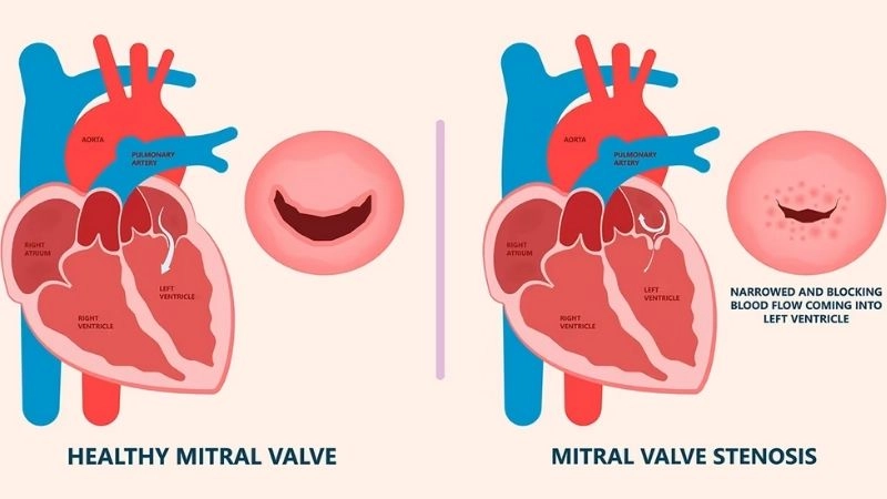 Mitral Stenosis Treatment helps improve blood circulation