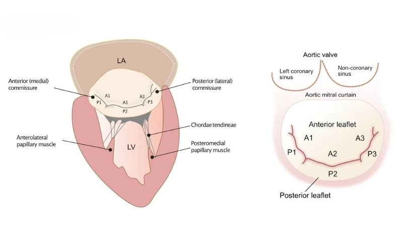 Mitral Valve Stenosis Surgery restores valve opening