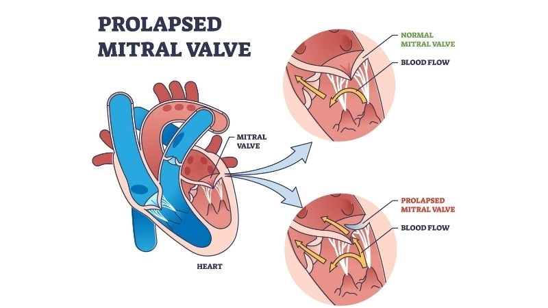 Mitral Valve Prolapse Symptoms include palpitations and fatigue