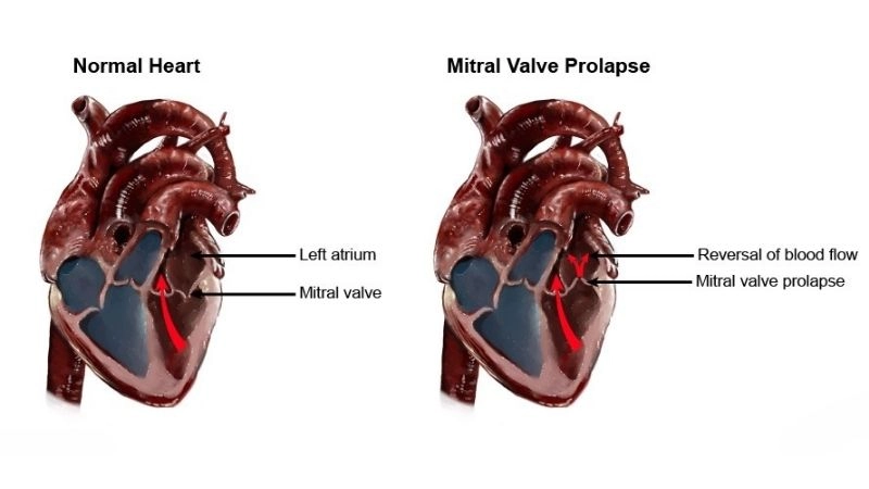 Mitral Valve Prolapse Treatment helps manage mild cases
