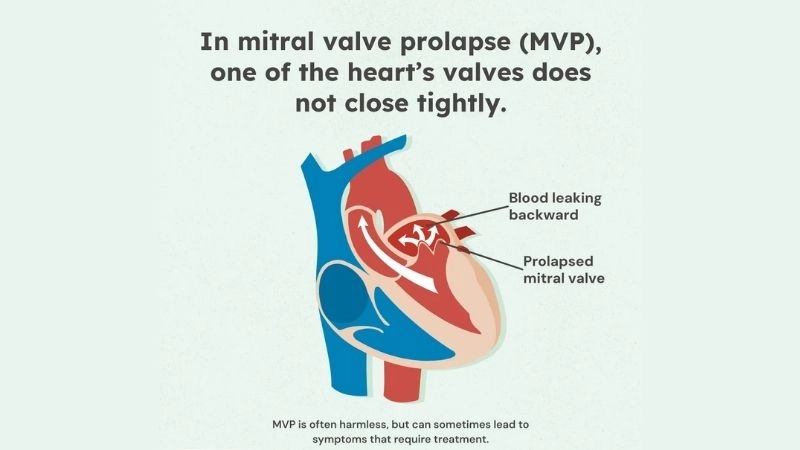 Mitral Valve Prolapse Causes linked with valve weakness