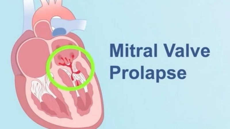 Mitral Valve Prolapse And Exercise usually safe with care