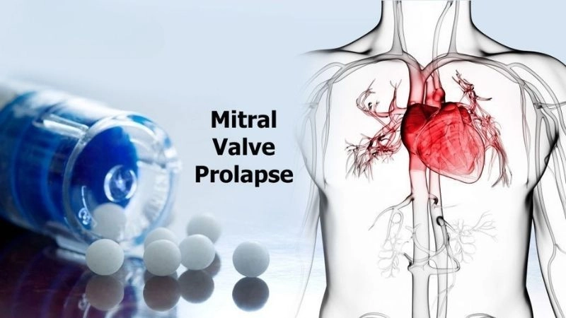 Mitral Valve Prolapse Surgery used for severe cases