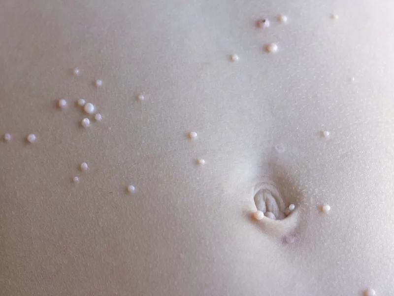 Molluscum Contagiosum treatment tips