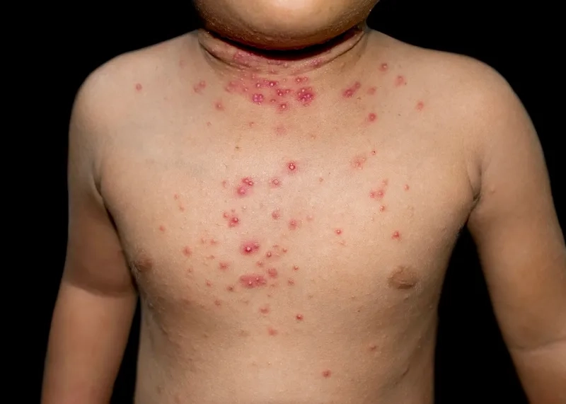 Molluscum Contagiosum symptoms guide