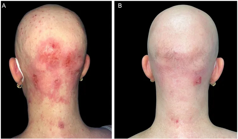 Molluscum Contagiosum in adults care