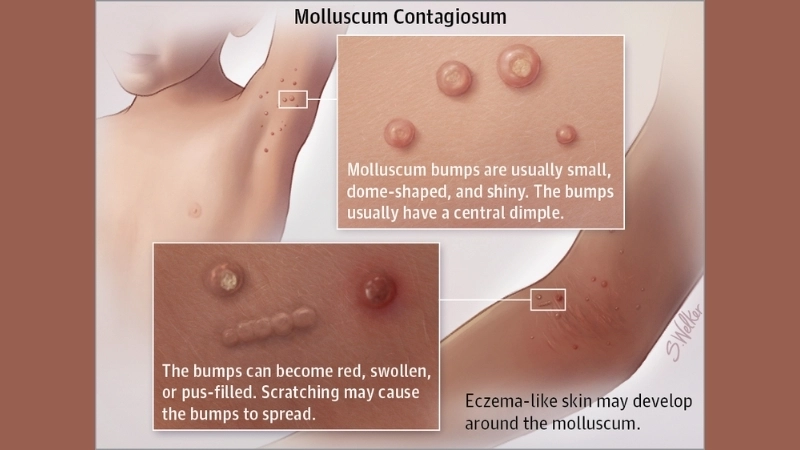 Molluscum Contagiosum cream option