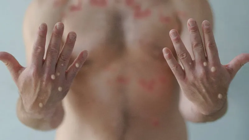 A visual guide explaining what is mpox