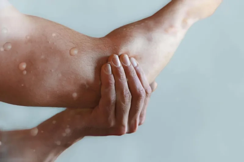 Comparing the rashes of mpox vs chickenpox