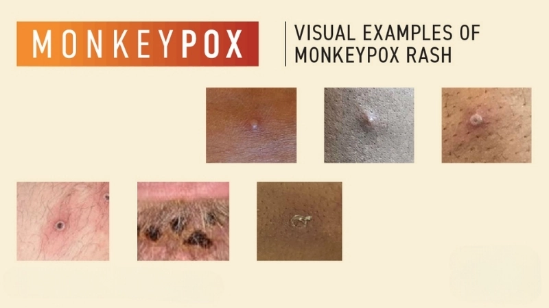 Mpox (formerly Monkeypox) shows mPox symptoms clearly