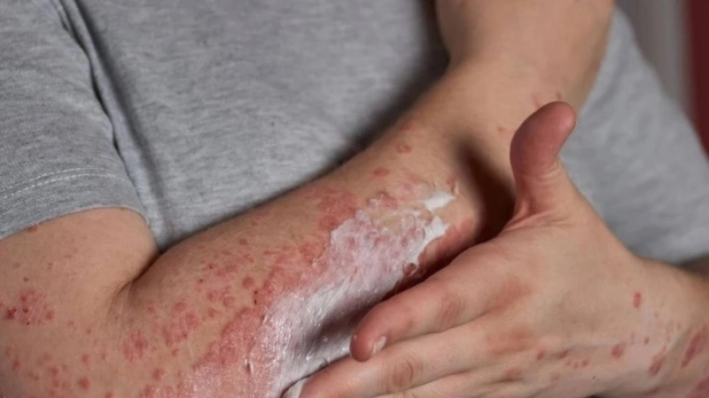 Mpox (formerly Monkeypox) detects mPox virus quickly