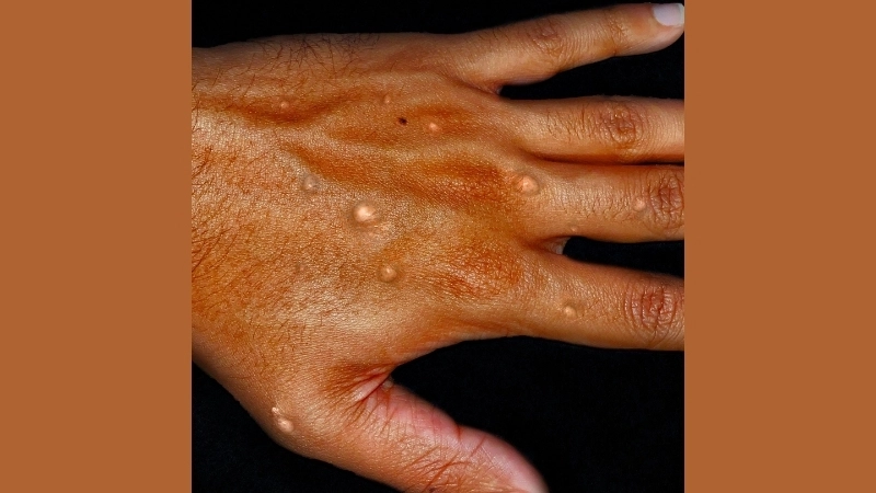 Mpox (formerly Monkeypox) guides mPox treatment safely