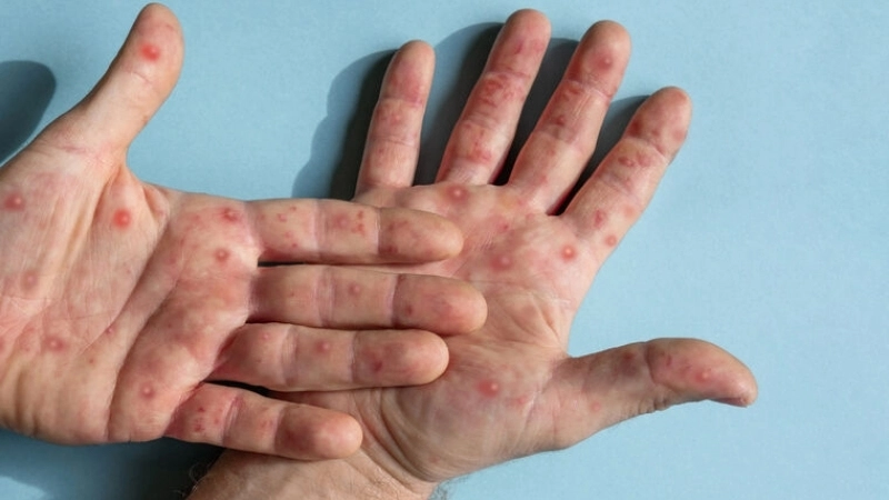 Mpox (formerly Monkeypox) warns mPox outbreak news