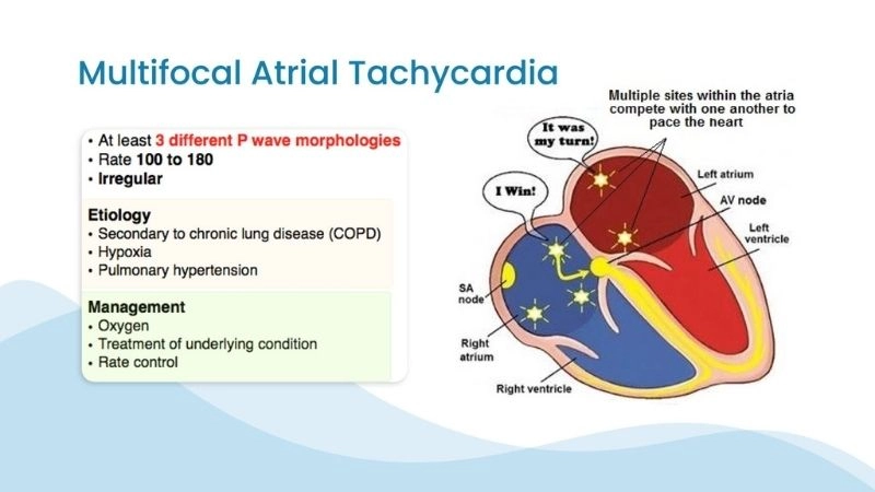 Multifocal Atrial Tachycardia Symptoms show irregular rhythm