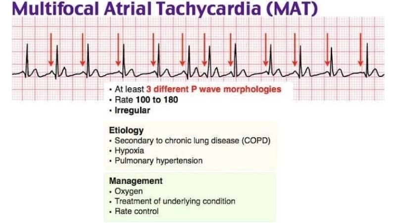 Multifocal Atrial Tachycardia Treatment restores heart balance