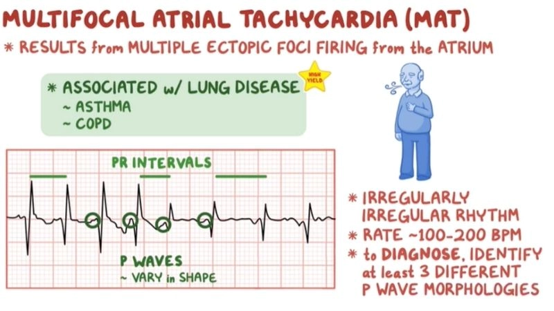 Causes Of Multifocal Atrial Tachycardia linked with lung disease