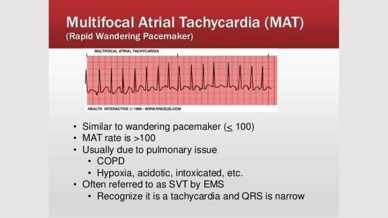 Multifocal Atrial Tachycardia In Elderly common heart issue