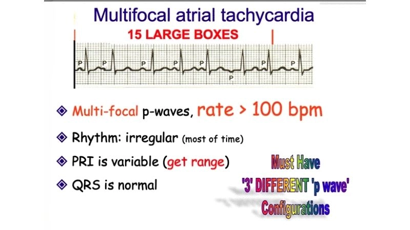 Multifocal Atrial Tachycardia Management helps stabilize rhythm