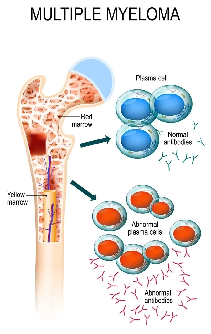 Signs of multiple myeloma and early detection