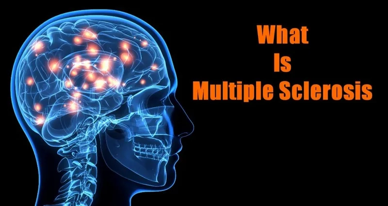 A diagram explaining what is MS