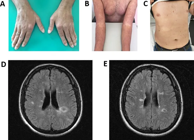 Recognizing the early signs of MS