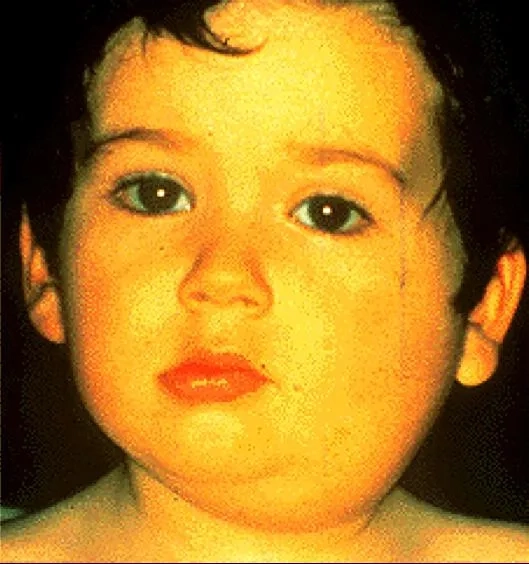 Key mumps signs and symptoms to watch for