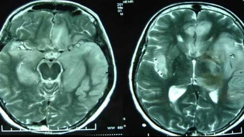 Murray Valley Encephalitis linked with Murray Valley fever