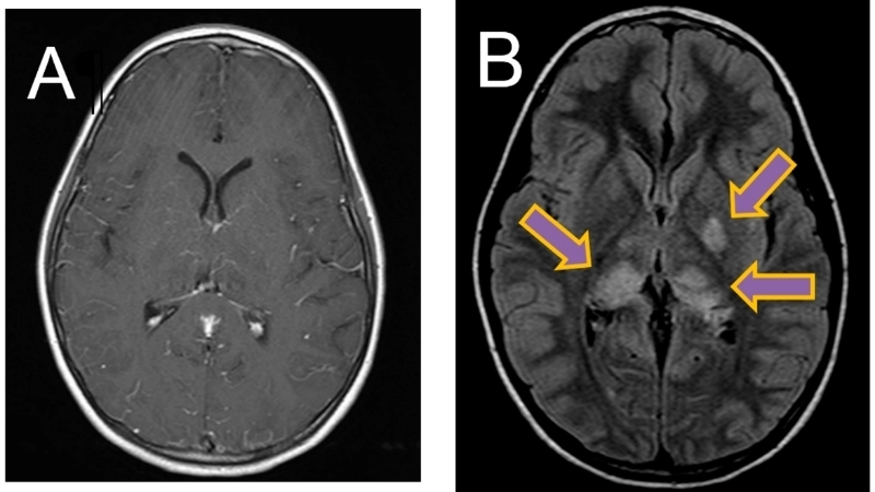 Murray Valley Encephalitis also called MVE risk