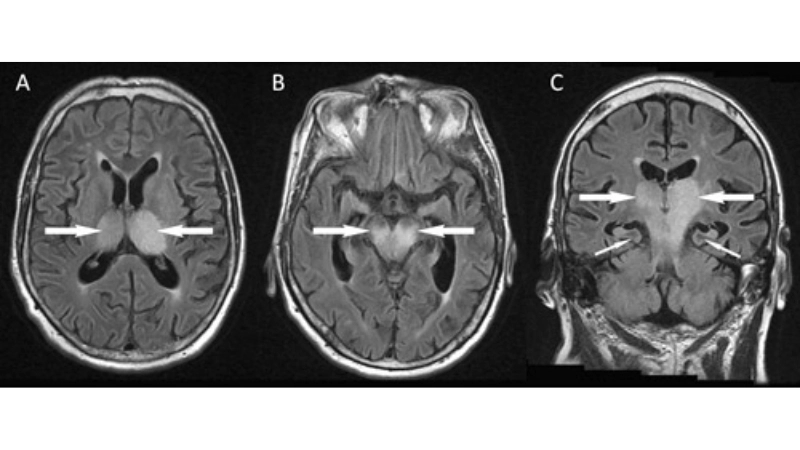 Murray Valley Encephalitis caused by MVE virus