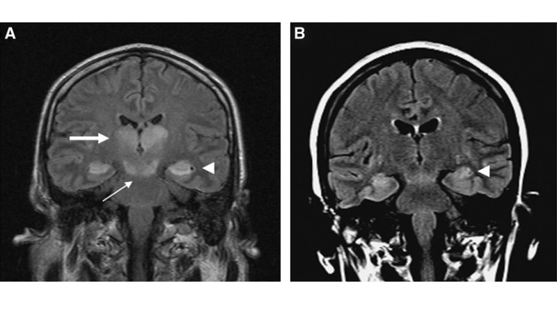 Murray Valley Encephalitis is a severe encephalitis virus