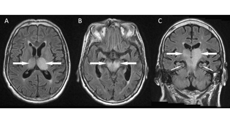 Murray Valley Encephalitis a mosquito-borne illness