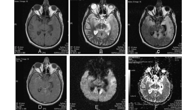 Murray Valley Encephalitis spread as an arbovirus threat