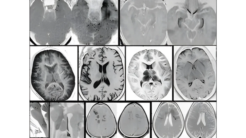 Murray Valley Encephalitis belongs to flavivirus family