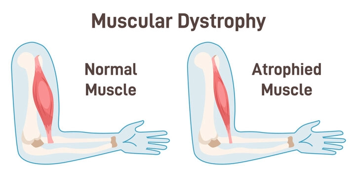 Facial muscle weakness characteristic of myotonic dystrophy