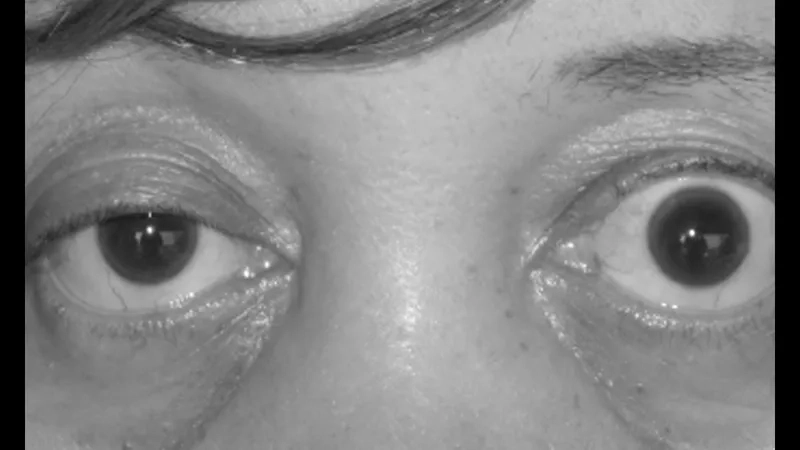 A clear example of ptosis in the eye